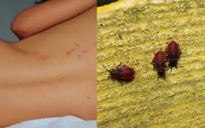 Les morsures des punaises de lit