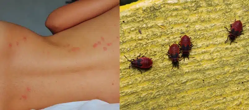 Les morsures des punaises de lit